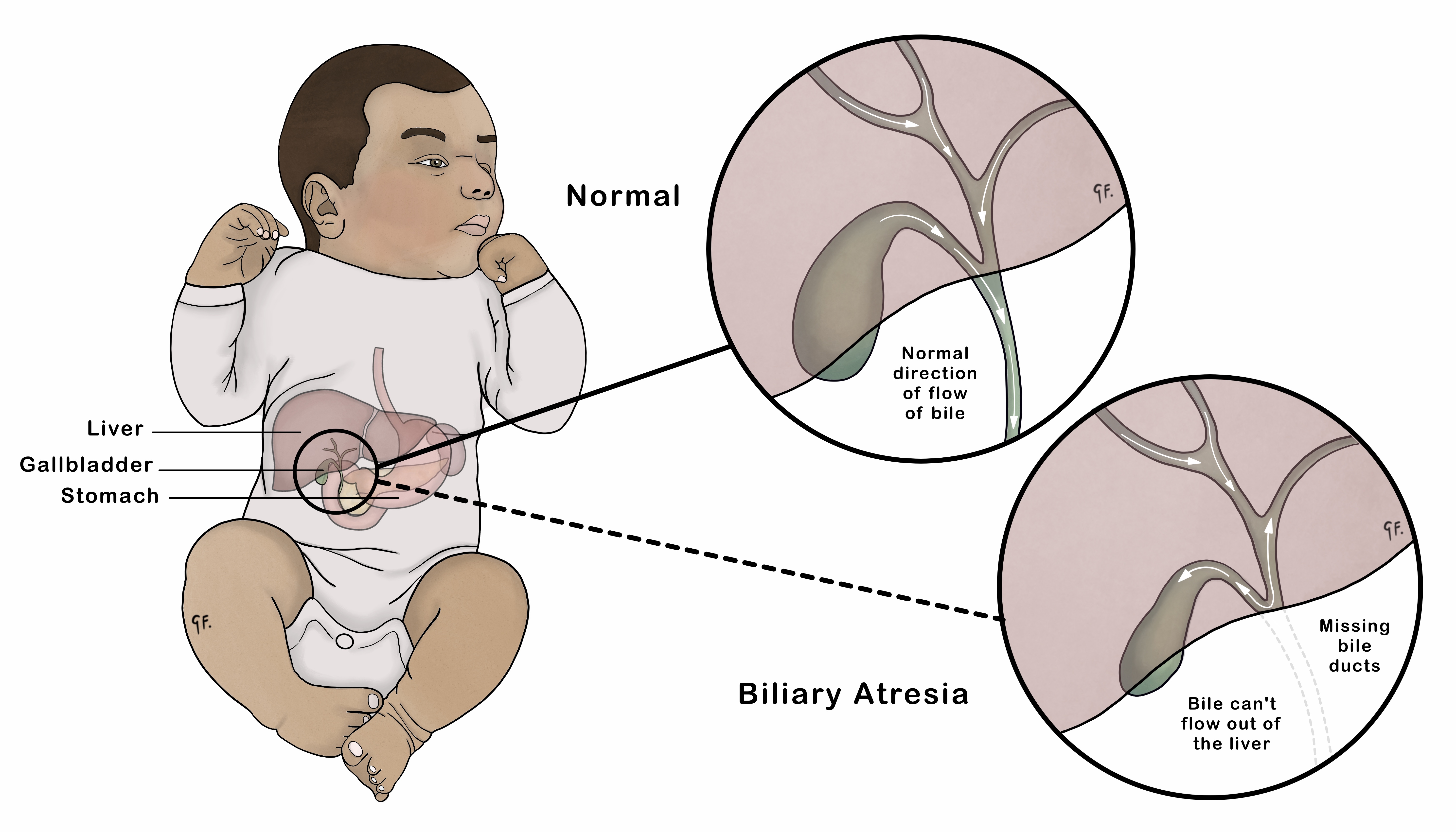 Biliary Atresia | KidsHealth NZ